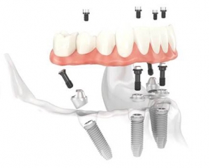 All-on-4® dental implants