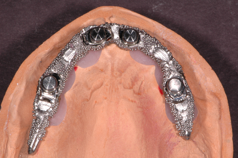 CAD/CAM Implant Bar Design in Arizona Titanium Dental Implant Bars