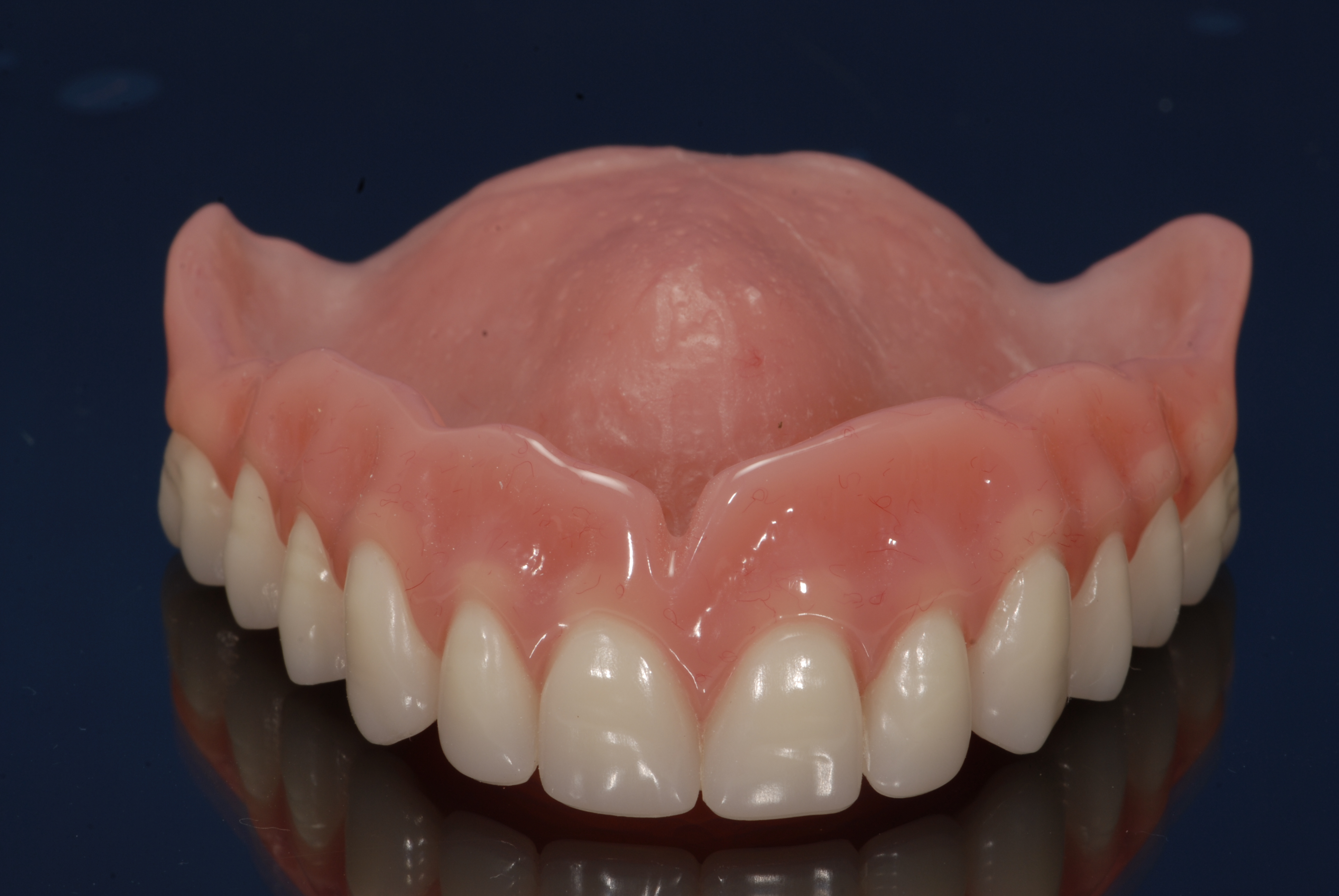 Dental Labs For Dentures In Arizona Conventional Full And Partial   Full Denture Top 