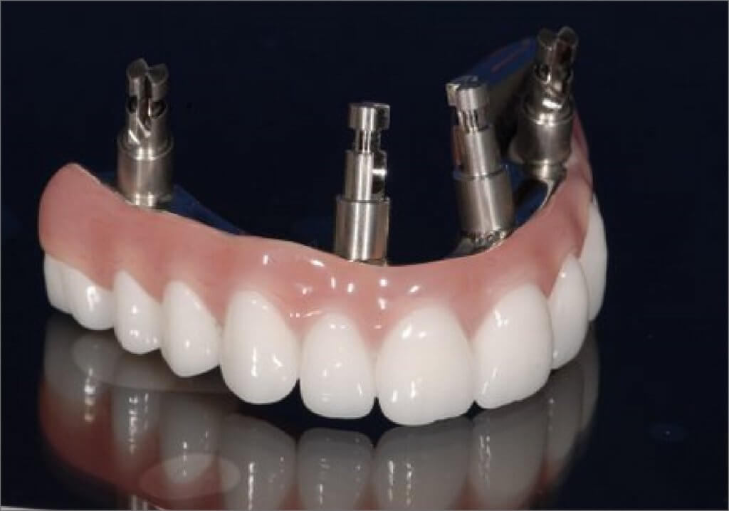 Arizona Denture Lab Implant Hybrid And Overdentures 2806