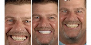 Image in 3 oblong sections, man smiling in all three first "existing denture", second, "Milled Try-in", Third "Final Ivotion Denture"